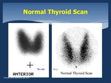 Nuclear Medicine - Thyroid - Procedure/Scan