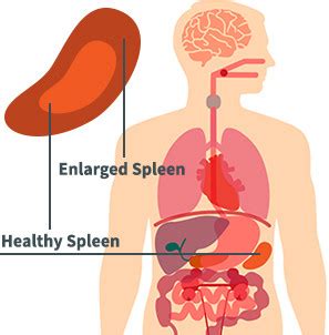 Spleen Surgery | Specialists in General Surgery - SGS