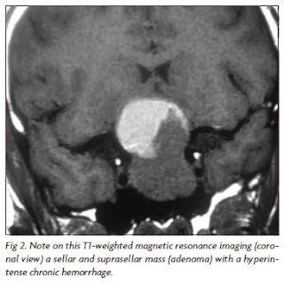 Kathy's MRI Pathology Blog: Pituitary Apoplexy