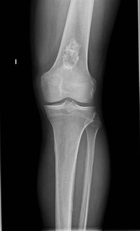 Chondroma in an Elderly Patient