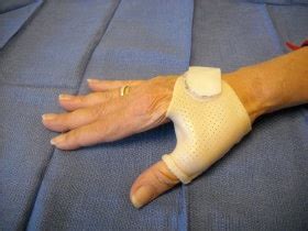 Thumb Basal Joint Arthritis | The Hand Doctor Is In! Thumb Basal Joint Arthritis | Greg ...