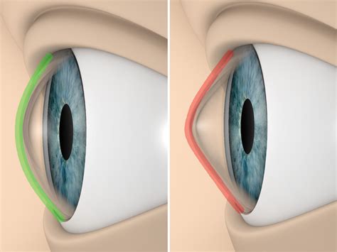 Keratoconus - Al Manal Eye Hospital