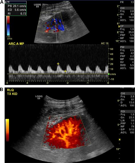 Spectral doppler waveforms ultrasound and color power image of the ...