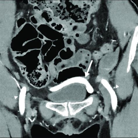 (PDF) A Very Low-Positioned Aortic Bifurcation