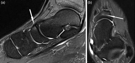 Imaging of tarsal navicular stress injury with a focus on MRI: A pictorial essay - Harris - 2016 ...