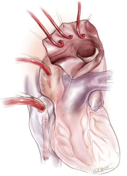 Aortic Arch Surgery - Dr Andrie Stroebel - Gold Coast Cardiothoracic Surgeon, Southport