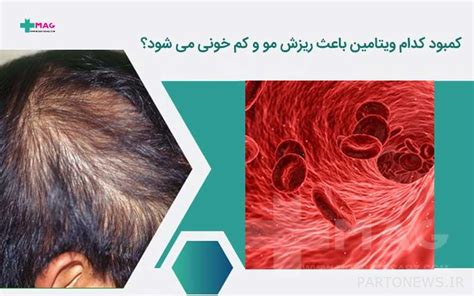 Which vitamin deficiency causes hair loss and anemia? | پرتو نیوز