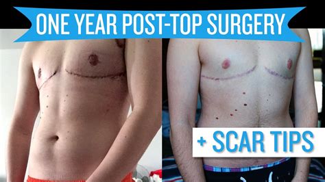 One Year Post Top Surgery + Scar Tips - YouTube