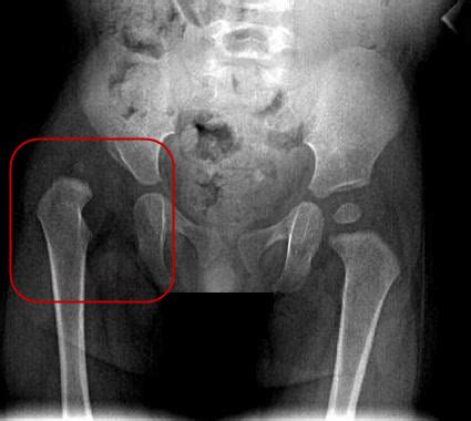 X-ray Screening - International Hip Dysplasia Institute