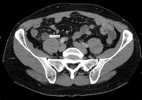 Acute Appendicitis - Clinical Features - Management - TeachMeSurgery