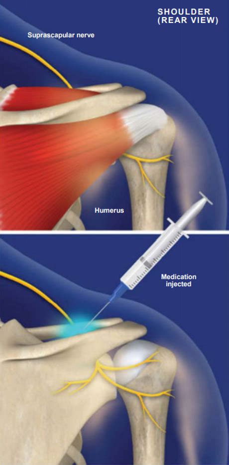 Suprascapular Nerve Block | Shoulder Pain Injection