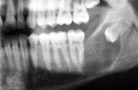 Odontogenic Keratocyst Clinical Features