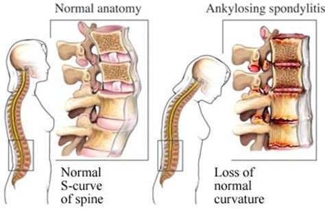 Ankylosing Spondylitis(AS) : Symptoms, Causes, Treatments and Exercises » How To Relief