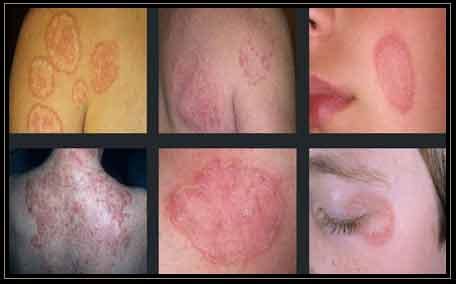 Ringworm (Tinea Corporis) | Faces Cosmetic Lasers Center