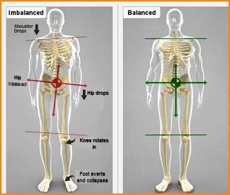 treatment options for lateral pelvic tilt Archives - Mobility ...