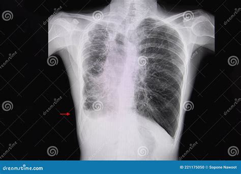 Bronchiectasis Chest X Ray