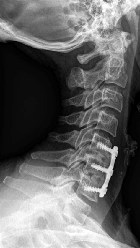 Complications of Neck and Spine Apparatus: a gallery