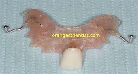 Flipper | Single Tooth Partial Denture | Dentist Orange Woodbridge CT