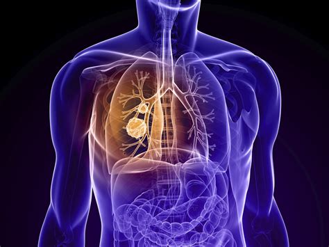 bone cancer symptoms pictures Bone scan cancer spots metastases showing mets normal rays areas ...