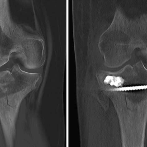 Reduction of the fracture (preoperative versus postoperative, computed... | Download Scientific ...