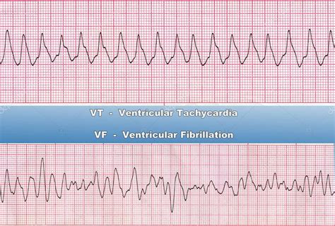 Ventricular Tachycardia Rhythm