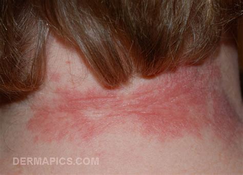 Red spots and rash: the most common types compared