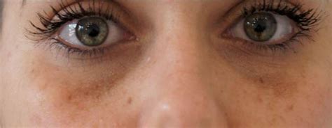 5 Top Home Remedies for Brown Spots Under Eyes - Skincarederm