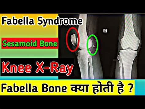 Knee joint Xray findings | Fabella Bone X-ray | Fabella syndrome ? Xray Knee | UdayXray - YouTube