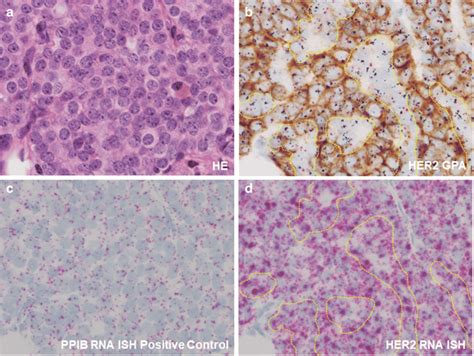 Pathological images of a HER2-positive breast cancer with HER2 ...