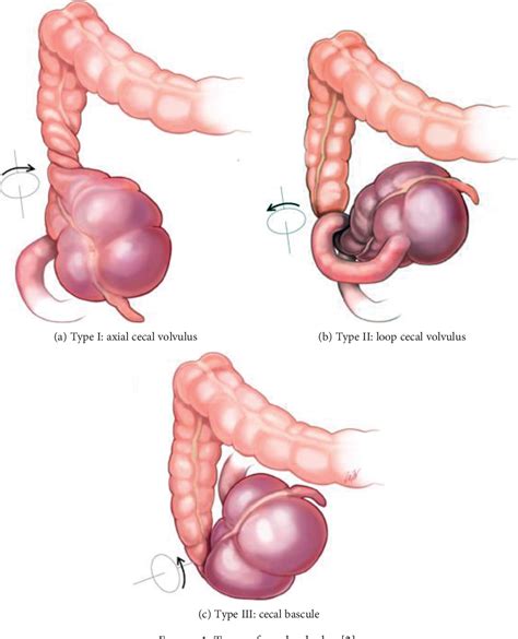 [PDF] Is Loop Ileostomy in Patients with Cecal Bascule a Viable Option ...