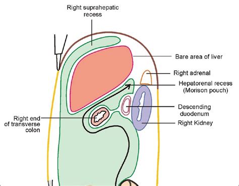 Medical Terms & Сlinical Сases : Morison’s pouch