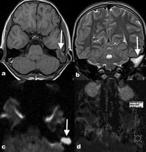 A case of left middle ear cholesteatoma. MRI shows hypointense on... | Download Scientific Diagram