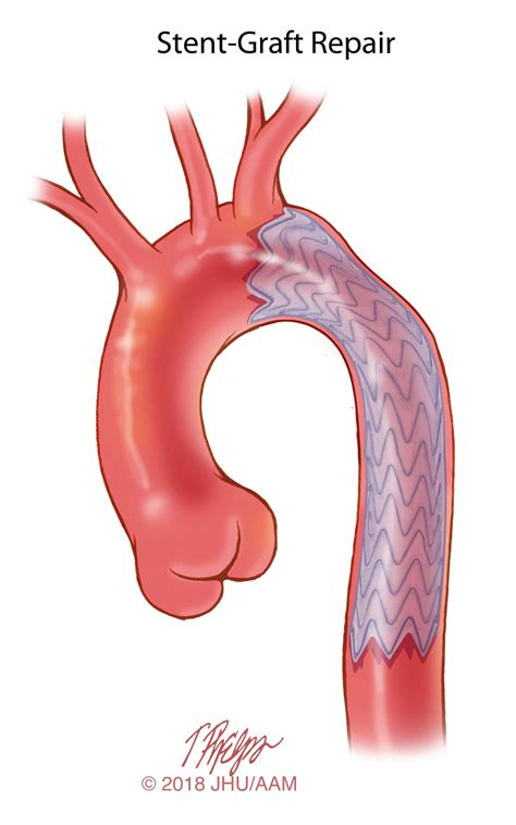 Adult Congenital Aortic Syndrome | Johns Hopkins Medicine