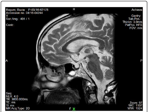 MRI brain of the patient showing partial empty sella. | Download ...