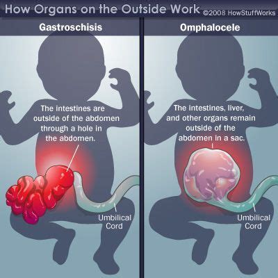 Gastroschisis / Omphalocele | NCLEX Prep and Study Resource | Pinterest | Nicu nursing, Medical ...