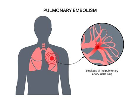 3 Symptoms of Pulmonary Embolism - Kingwood Emergency Hospital