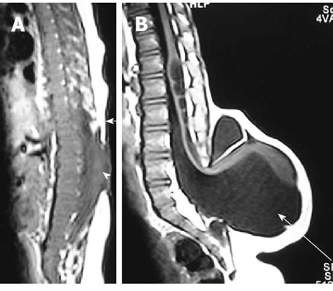 Myelocele and myelomeningocele. Sagittal T1 weighted images of spine in... | Download Scientific ...