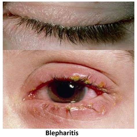 What Causes Blepharitis Swollen Eyelids