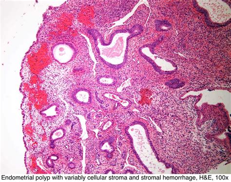 Pathology Outlines - Endometrial polyp