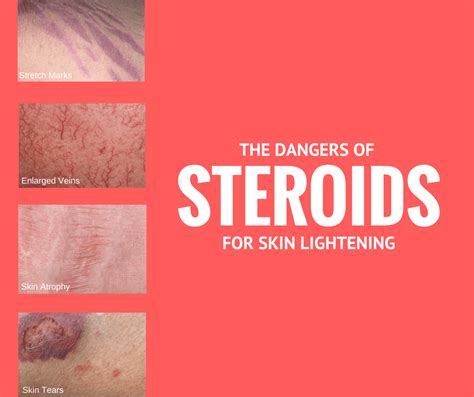 The Risks of Skin Lightening Creams with Steroids