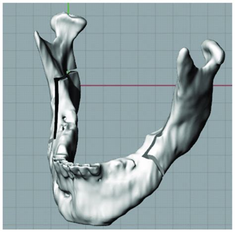 Bilateral sagittal split osteotomy. | Download Scientific Diagram