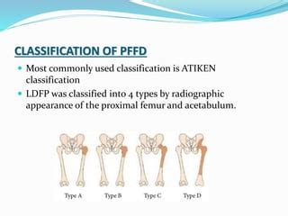 PFFD [proximal femoral focal deficiency] | PPT