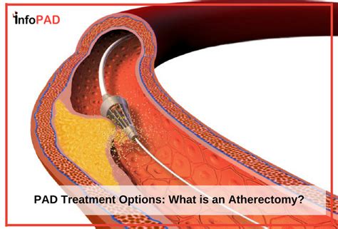 PAD Treatment Options: What is an Atherectomy? | Azura Vascular Care