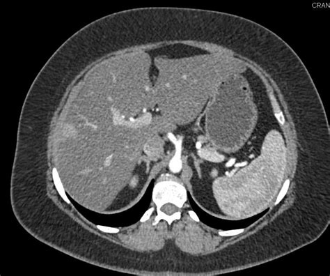 Perfusion Changes in the Liver - Liver Case Studies - CTisus CT Scanning