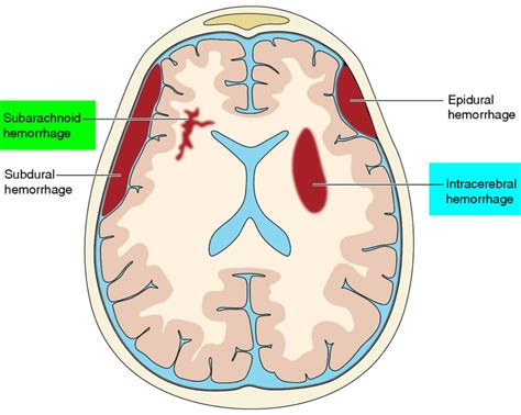 Ischemic Stroke - Causes, Signs, Symptoms & Ischemic Stroke Treatment