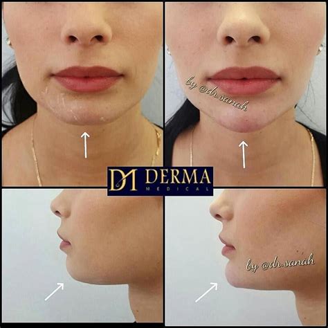 Chin Sculpting + Jawline Botox Please email clinics@dermamedical.co.uk ...