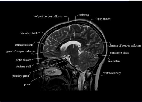 Brain Mri Labeled