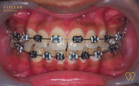 Braces Colors: Top Picks For 2023 - Stellar Dental