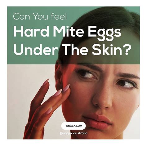 Can you feel hard Demodex mite eggs under the skin? | Ungex in 2020 | Demodex mites, Demodex ...