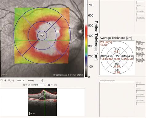 DME optical coherence tomography - American Academy of Ophthalmology